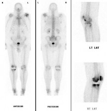 nm nuclear medicine scans bone mdp useful which