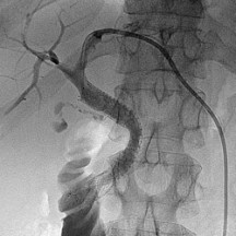 transjugular liver biopsy